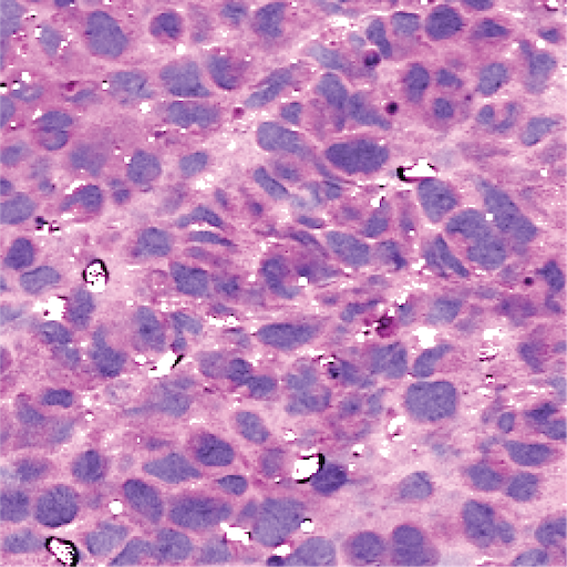 Small Cell Carcinoma